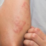 manchas vermelhas na pele