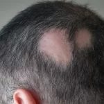 Alopecia