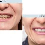O que são facetas dentárias