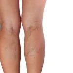 Remédio caseiro para eliminar derrames nas pernas